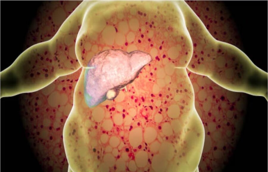 Foods That Increase Fatty Liver Risk