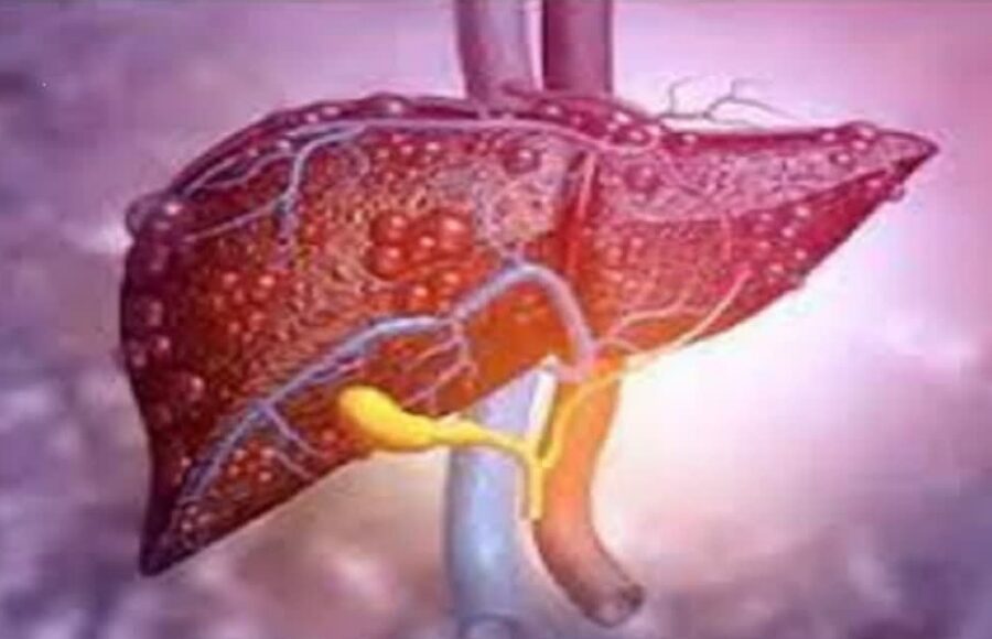 liver disease symptoms